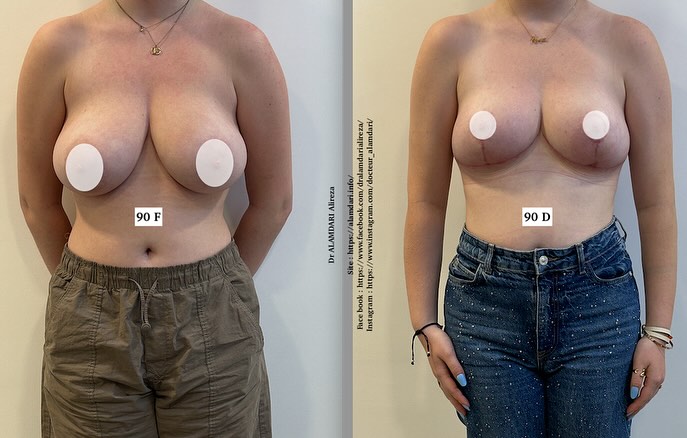 Réduction mammaire, avec des cicatrices en T inversé.